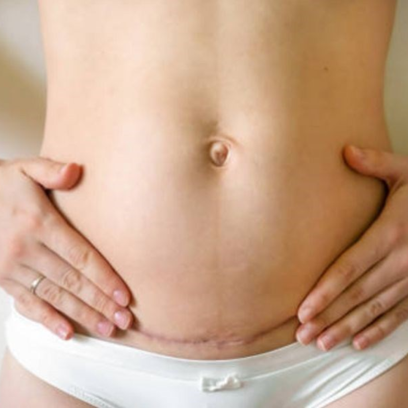 Kiêng cữ sau sinh mổ những điều mẹ nên biết