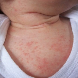 Có nhiều nguyên nhân làm trẻ em bị rôm sảy
