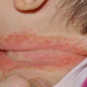 Rôm sảy ở trẻ sơ sinh có thể tự hết hoặc thông qua các biện pháp xử lý