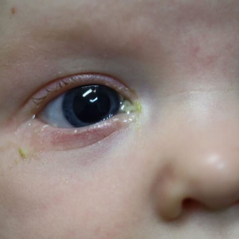 Đa số các trường hợp tắc tuyến lệ không nguy hiểm 