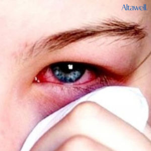 Đau mắt đỏ khiến mắt bị sưng và cộm ngứa khó chịu