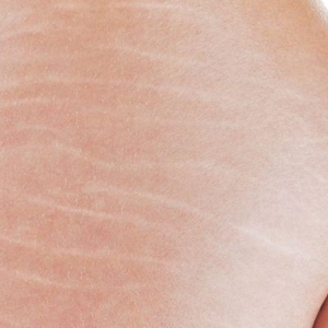 Rạn da đỏ có thể mờ đi nếu bạn can thiệp sớm