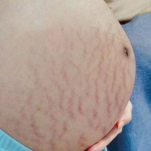 Rạn da đỏ khá phổ biến ở các mẹ bầu