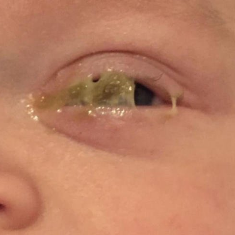 Rất hay bắt gặp hiện tượng mắt đổ ghèn ở trẻ em