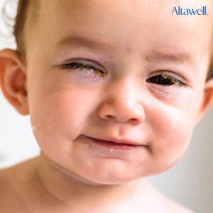 Tắc tuyến lệ nếu không để ý kỹ thì rất khó phát hiện