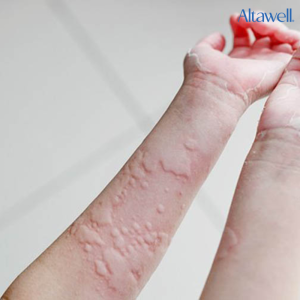Nổi mề đay sau sinh khiến da xuất hiện các vết sưng phù màu hồng nhạt