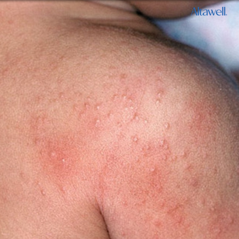 Rôm sảy khiến da bé xuất hiện các mụn nước nhỏ và mẩn đỏ